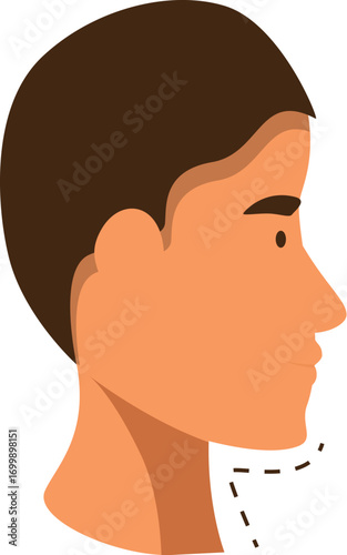 Illustration of mentoplasty showing chin reduction lines on a patient