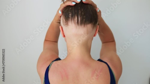 a woman showing of experiencing hair loss due to alopecia, an autoimmune condition exacerbated by COVID 19. She reveals her bald head, the importance of self acceptance