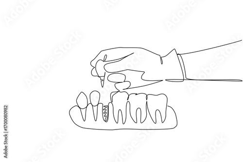 Continuous line drawing of dental implant procedure with hand placing artificial tooth, symbolizing oral health, medical innovation, and assistive technology concept for global awareness day.