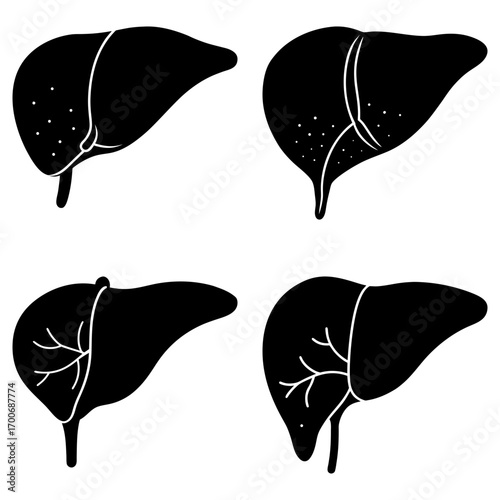 Four liver illustrations showing different conditions and anatomical variations in black and white style