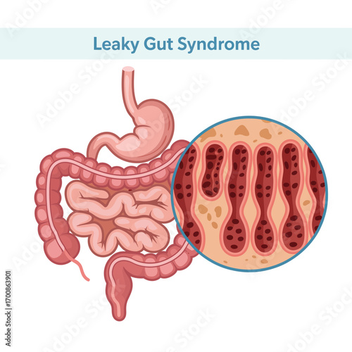 Illustration of leaky gut syndrome showing intestinal permeability and inflammation