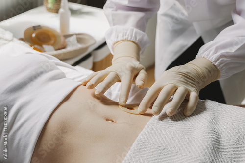 A nurse applies a sticky circle to a patient's colostomy bag.
