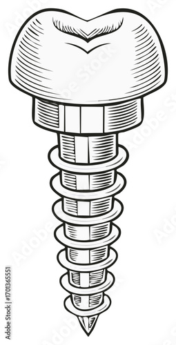 Vintage style drawing of a complete dental implant with tooth crown