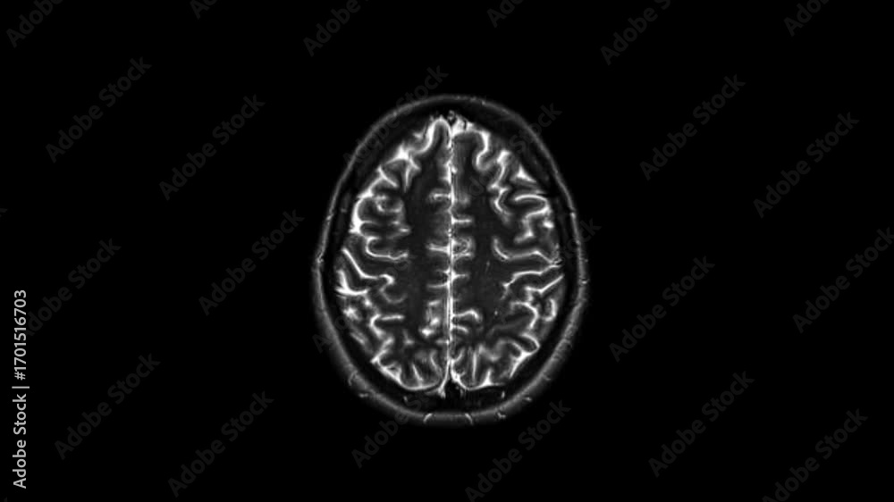 Black and White MRI Scan of Human Brain Detailed Cross Sectional ...