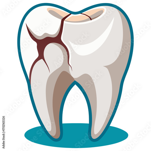 Vector Illustration of a Broken Molar Tooth with Severe Cavities.