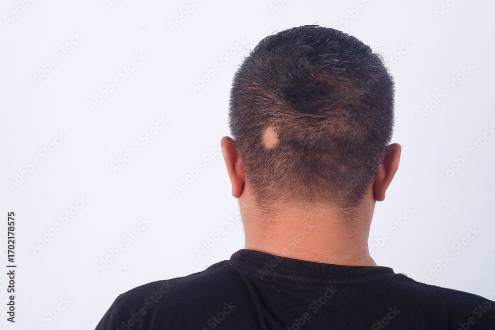 Obraz premium Back view of a man with alopecia areata on the scalp, showing a bald patch on the head. Hair loss problem, dermatology, and healthcare concept.