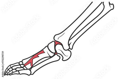 Illustration of the bones of the human foot and ankle with a highlighted metatarsal bone