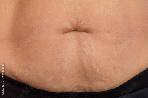 Close up of loose skin and belly button on lower abdomen