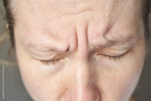 Photos close up of caucasian female forehead with frown lines and furrowed brows showing skin texture and expression