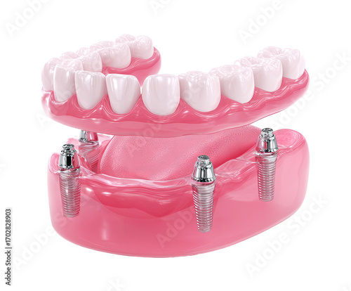 Dental implant-supported denture.  Pink denture with teeth and metal implant posts.  3D render of dental prosthesis