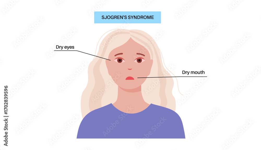 Fototapeta premium Sjogrens syndrome disease