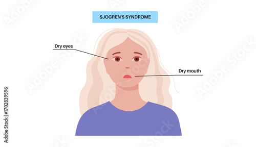 Sjogrens syndrome disease