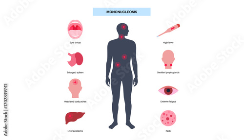 Mononucleosis symptoms poster
