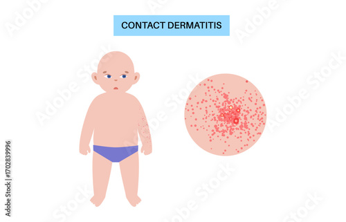 Contact dermatitis poster