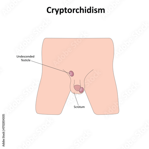 Cryptorchidism vector illustration