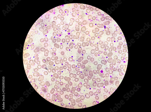 Принти на полотні Microscopic blood smear show leucocytopenia or leucopenia a state of decrease white blood cell (WBC)