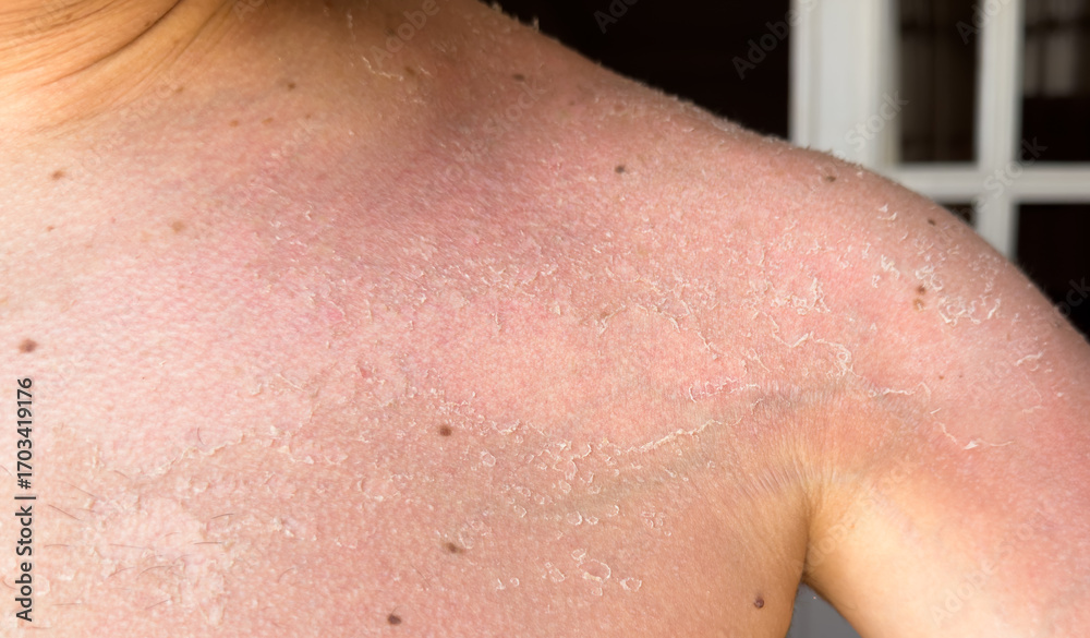 Naklejka premium Sunburn, peeling skin, burns, skin problem, vertigo, health, summer and sun. High quality