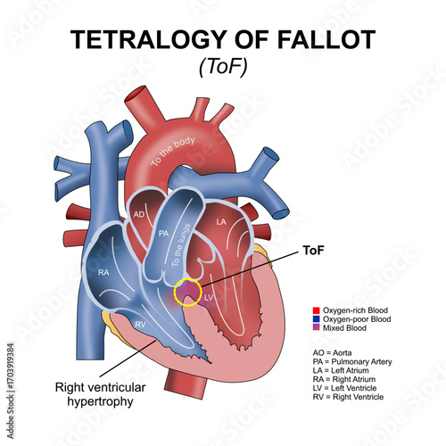Tetralogy of Fallot (ToF) Heart Flashcard