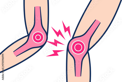 Illustration of two elbows experiencing pain and inflammation with lightning bolt symbols