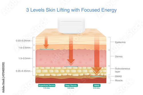 Medical device shoot heat energy to the skin layer at three different depths. Facial Skin lifting treatments with stimulating collagen and Elastin in the skin with Ultherapy and Radio Frequency Device