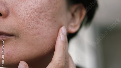 Scars after acne on womans face skin. Problem skin treatment. Close up.