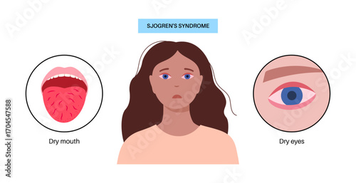 Sjogrens syndrome disease