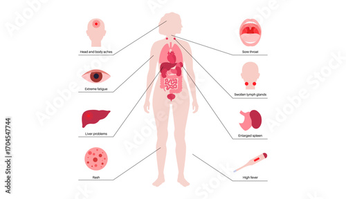 Mononucleosis symptoms poster
