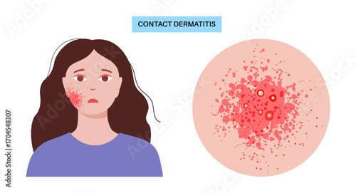 Contact dermatitis poster