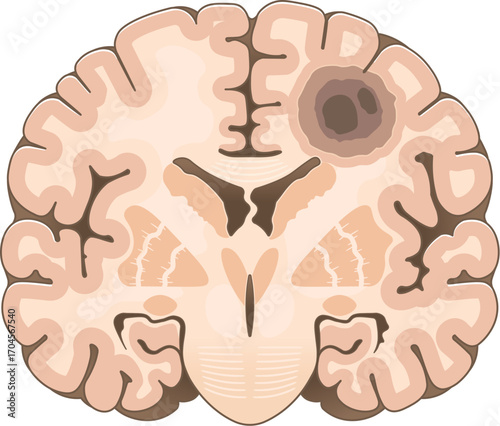 前頭断面_脳腫瘍のイラスト Brain tumor illustration