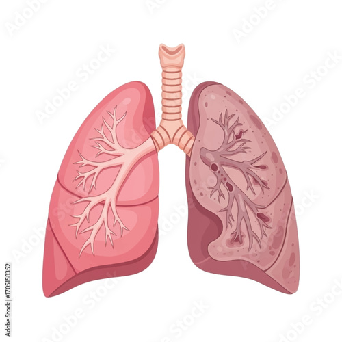 Anatomical Illustration of Healthy and Diseased Lungs