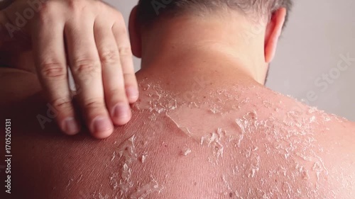 Close up footage of sunburn on the skin. Man scratches his back after burning the sun. Dry skin in need of treatment and hydration.