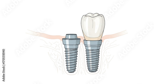 Dental Implant and Crown Illustration.
