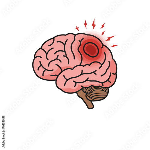 brain aneurysm with red lightning indicating neurological damage and health issues perfect for medical publications illustrating stroke and illness.