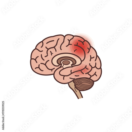 brain inflammation illustration showing brain damage highlighted in red suitable for medical education and healthcare awareness campaigns.