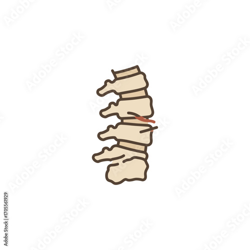 herniated disc illustration showing spinal disc bulge with pinched nerve depicting back pain and medical condition ideal for healthcare content