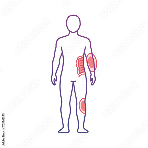 IBD inflammation on body showing inflamed gut elbow knee highlighting ulcerative colitis and crohns disease perfect for medical illustration.