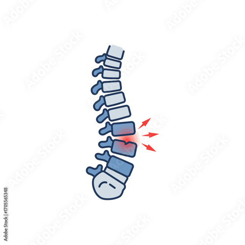 spinal injury illustration showing lower back pain radiating outwards ideal for medical education depicting disc herniation and nerve compression