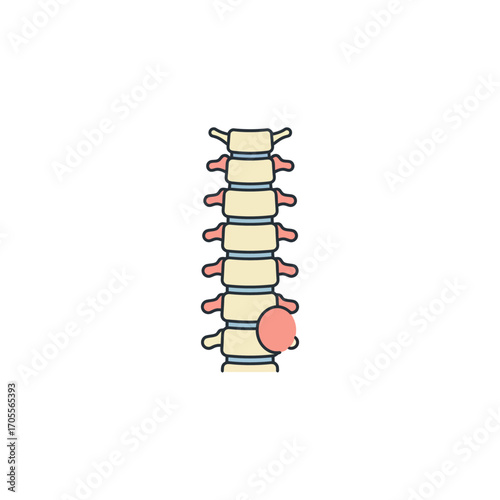 Spinal tumor illustration showing growth on the vertebrae perfect for medical textbooks educational material healthcare awareness and spine health information