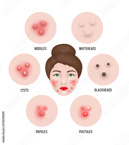 Acne. Types of acne. Vector illustration