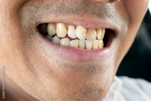 Fotografia Male crooked upper front tooth
