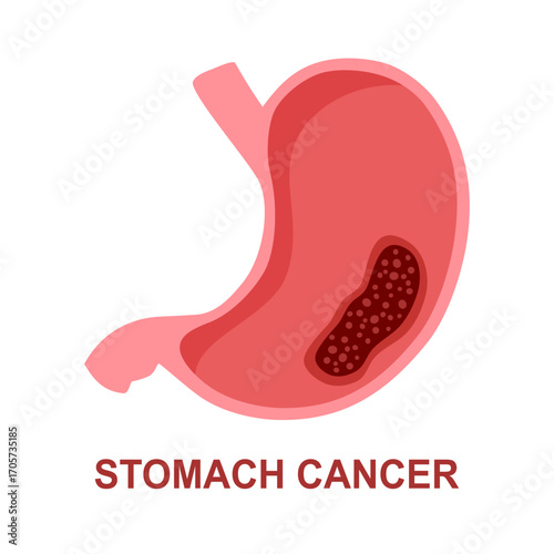 Stomach cancer. Malignant cancerous tumor enlarged under magnifying glass. Anatomical vector illustration isolated white background cartoon style