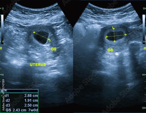 Ultrasonography of 7 weeks baby radiology	
