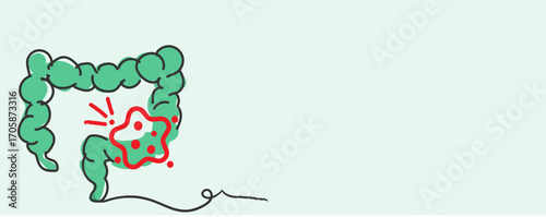 Early Detection of Colorectal Cancer Screening and Prevention Strategies