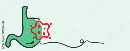  Understanding Stomach Cancer Early Detection, Diagnosis, and Prevention