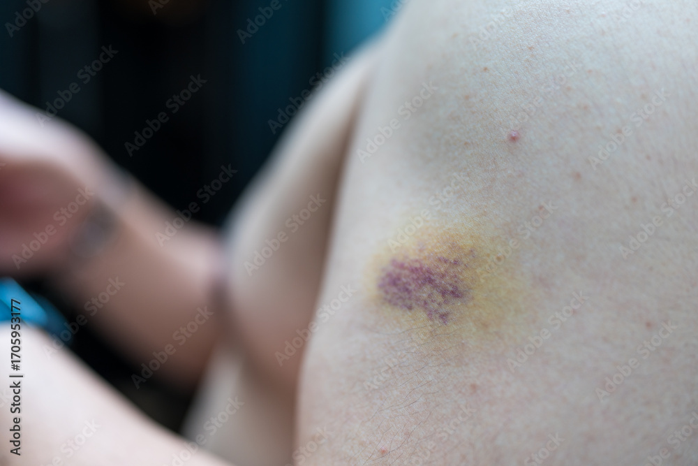 Fototapeta premium Close up of a bruise in the arm of man
