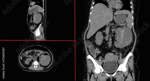 Obraz na płótnie Renal subcapsular abscess is a suppurative process localized to a single area of the kidney