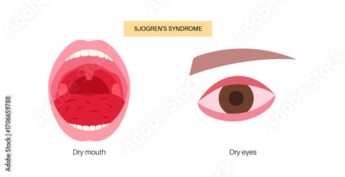 Sjogrens syndrome disease