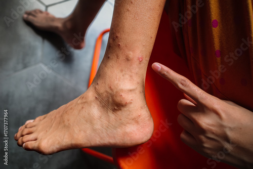 A girl pointing her finger on itchy skin rash and red spot wound on her leg due to mosquito bites scratching