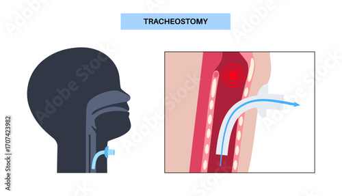 Tracheostomy medical poster