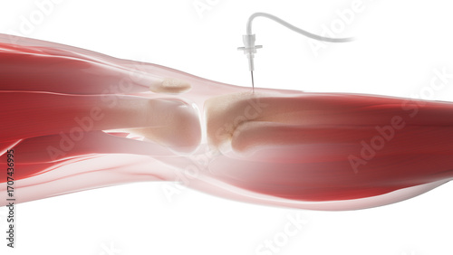 Intraosseous infusion in shin bone, illustration